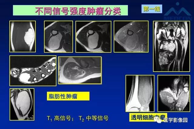 【PPT】软组织肿瘤鉴别诊断：MR作用