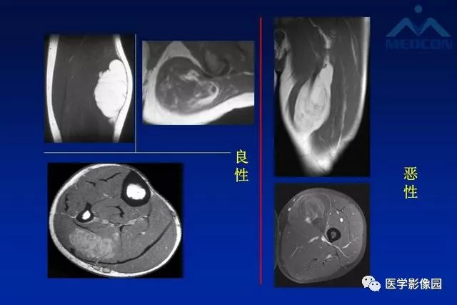 【PPT】软组织肿瘤鉴别诊断：MR作用
