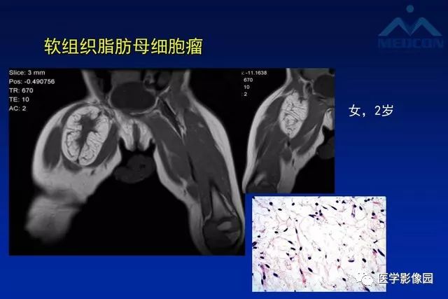 【PPT】软组织肿瘤鉴别诊断：MR作用
