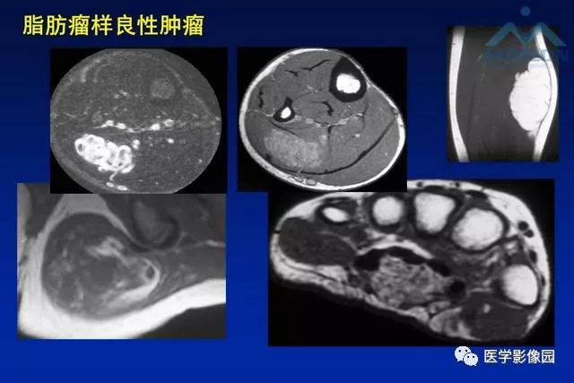 【PPT】软组织肿瘤鉴别诊断：MR作用