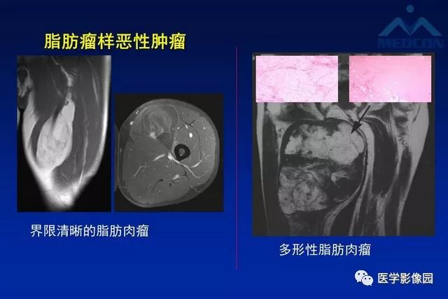 【PPT】软组织肿瘤鉴别诊断：MR作用