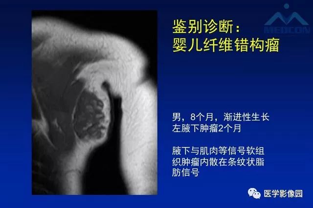 【PPT】软组织肿瘤鉴别诊断：MR作用
