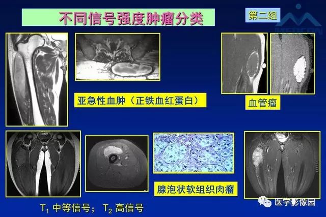 【PPT】软组织肿瘤鉴别诊断：MR作用
