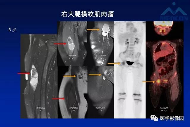 【PPT】软组织肿瘤鉴别诊断：MR作用