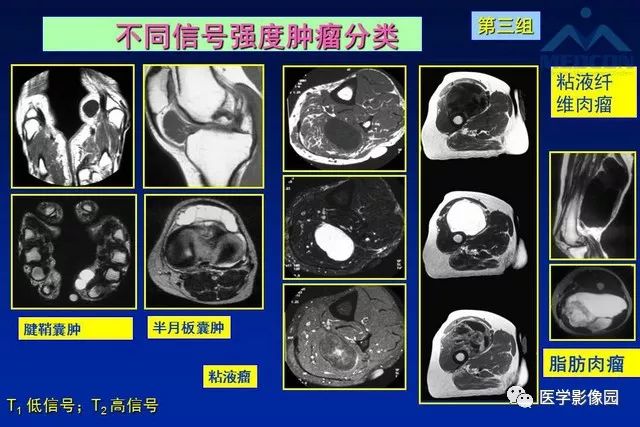 【PPT】软组织肿瘤鉴别诊断：MR作用