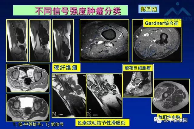 【PPT】软组织肿瘤鉴别诊断：MR作用