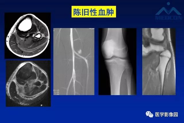 【PPT】软组织肿瘤鉴别诊断：MR作用