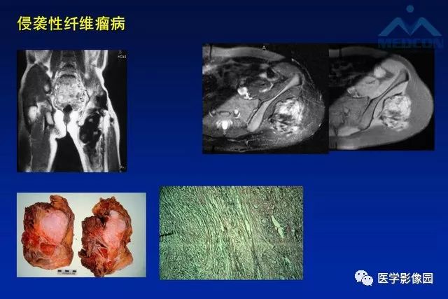 【PPT】软组织肿瘤鉴别诊断：MR作用