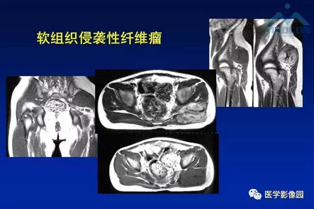 【PPT】软组织肿瘤鉴别诊断：MR作用