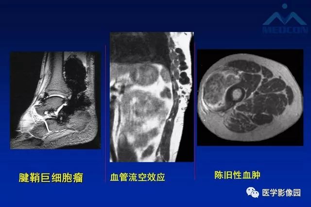 【PPT】软组织肿瘤鉴别诊断：MR作用