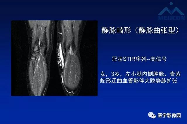 【PPT】软组织肿瘤鉴别诊断：MR作用