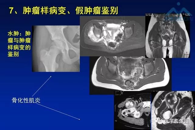 【PPT】软组织肿瘤鉴别诊断：MR作用