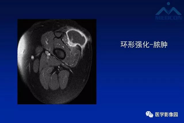 【PPT】软组织肿瘤鉴别诊断：MR作用