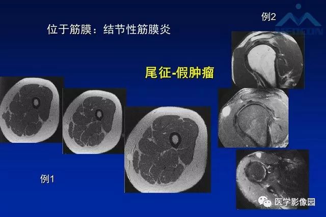 【PPT】软组织肿瘤鉴别诊断：MR作用