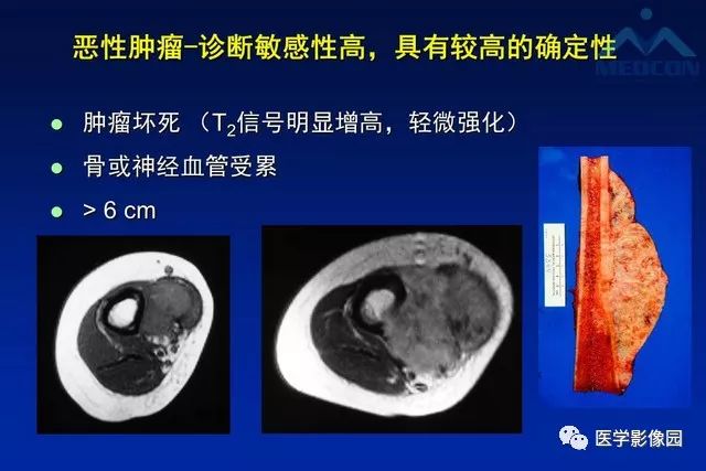 【PPT】软组织肿瘤鉴别诊断：MR作用