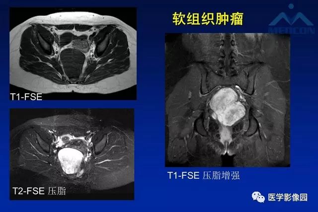 【PPT】软组织肿瘤鉴别诊断：MR作用