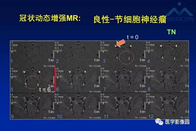 【PPT】软组织肿瘤鉴别诊断：MR作用