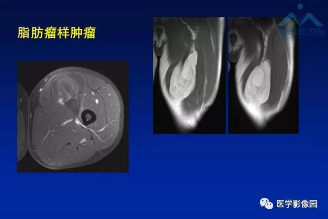 【PPT】软组织肿瘤鉴别诊断：MR作用