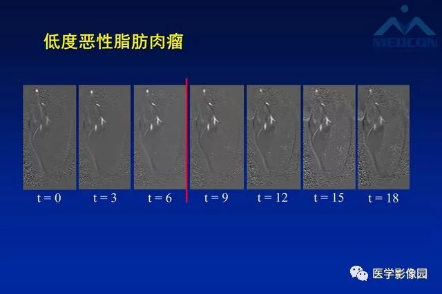 【PPT】软组织肿瘤鉴别诊断：MR作用