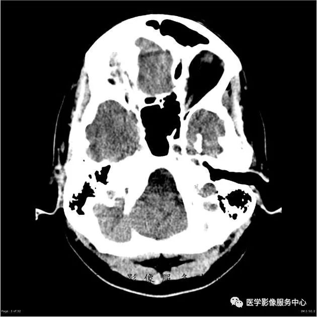 【病例】能在这个头颅CT上发现病变的都是高手—胚胎发育不良性神经上皮瘤1例 【病例】能在这个头颅CT上发现病变的都是高手—胚胎发育不良性神经上皮瘤1例