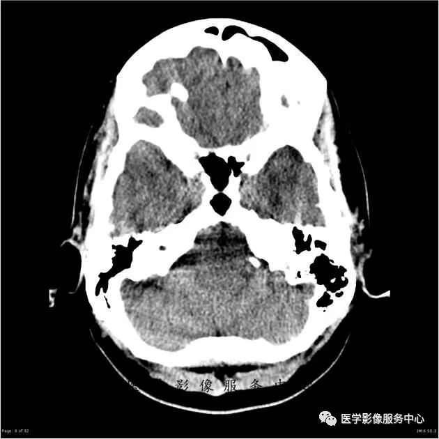 【病例】能在这个头颅CT上发现病变的都是高手—胚胎发育不良性神经上皮瘤1例 【病例】能在这个头颅CT上发现病变的都是高手—胚胎发育不良性神经上皮瘤1例
