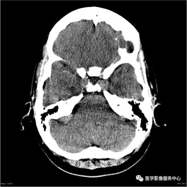 【病例】能在这个头颅CT上发现病变的都是高手—胚胎发育不良性神经上皮瘤1例 【病例】能在这个头颅CT上发现病变的都是高手—胚胎发育不良性神经上皮瘤1例