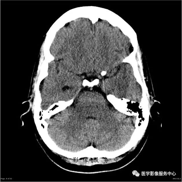 【病例】能在这个头颅CT上发现病变的都是高手—胚胎发育不良性神经上皮瘤1例 【病例】能在这个头颅CT上发现病变的都是高手—胚胎发育不良性神经上皮瘤1例