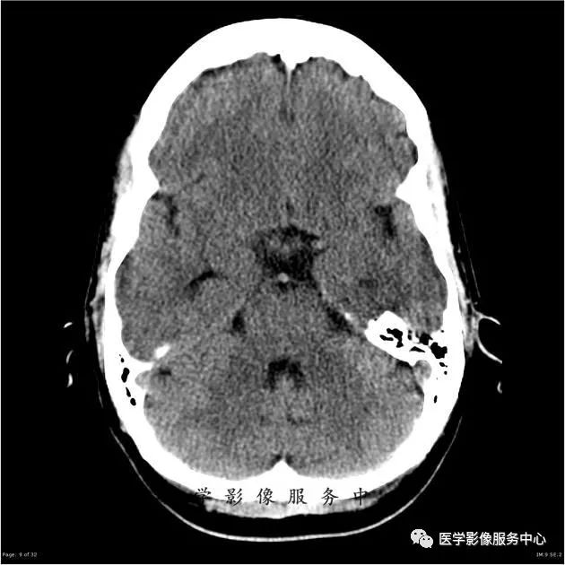 【病例】能在这个头颅CT上发现病变的都是高手—胚胎发育不良性神经上皮瘤1例 【病例】能在这个头颅CT上发现病变的都是高手—胚胎发育不良性神经上皮瘤1例