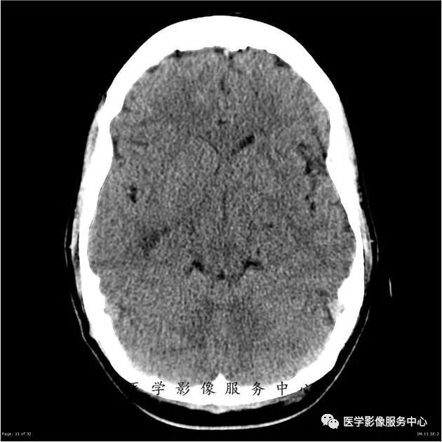 【病例】能在这个头颅CT上发现病变的都是高手—胚胎发育不良性神经上皮瘤1例 【病例】能在这个头颅CT上发现病变的都是高手—胚胎发育不良性神经上皮瘤1例