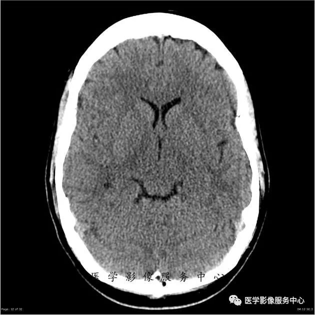 【病例】能在这个头颅CT上发现病变的都是高手—胚胎发育不良性神经上皮瘤1例 【病例】能在这个头颅CT上发现病变的都是高手—胚胎发育不良性神经上皮瘤1例