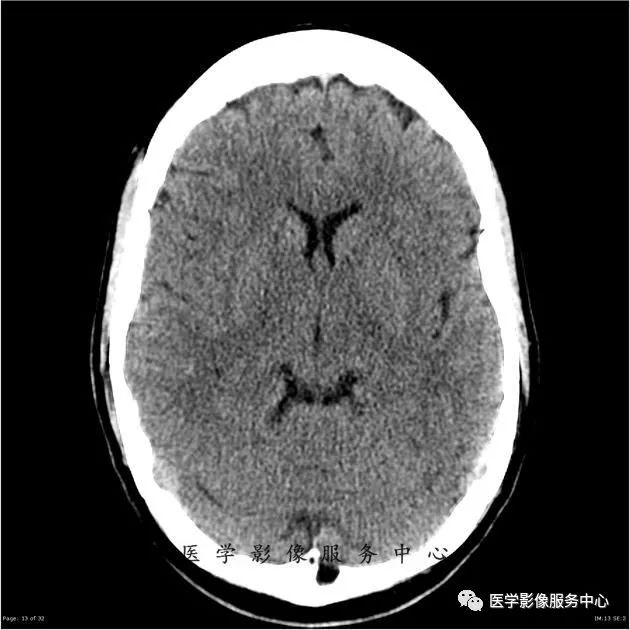 【病例】能在这个头颅CT上发现病变的都是高手—胚胎发育不良性神经上皮瘤1例 【病例】能在这个头颅CT上发现病变的都是高手—胚胎发育不良性神经上皮瘤1例