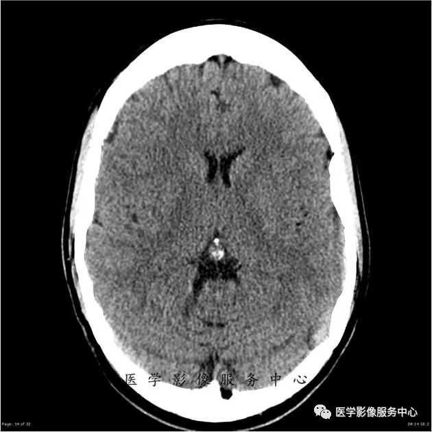 【病例】能在这个头颅CT上发现病变的都是高手—胚胎发育不良性神经上皮瘤1例 【病例】能在这个头颅CT上发现病变的都是高手—胚胎发育不良性神经上皮瘤1例