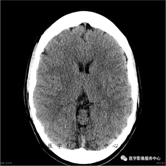 【病例】能在这个头颅CT上发现病变的都是高手—胚胎发育不良性神经上皮瘤1例 【病例】能在这个头颅CT上发现病变的都是高手—胚胎发育不良性神经上皮瘤1例
