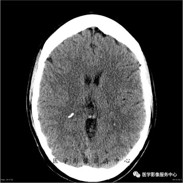 【病例】能在这个头颅CT上发现病变的都是高手—胚胎发育不良性神经上皮瘤1例 【病例】能在这个头颅CT上发现病变的都是高手—胚胎发育不良性神经上皮瘤1例