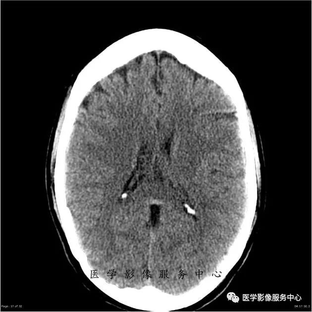 【病例】能在这个头颅CT上发现病变的都是高手—胚胎发育不良性神经上皮瘤1例 【病例】能在这个头颅CT上发现病变的都是高手—胚胎发育不良性神经上皮瘤1例