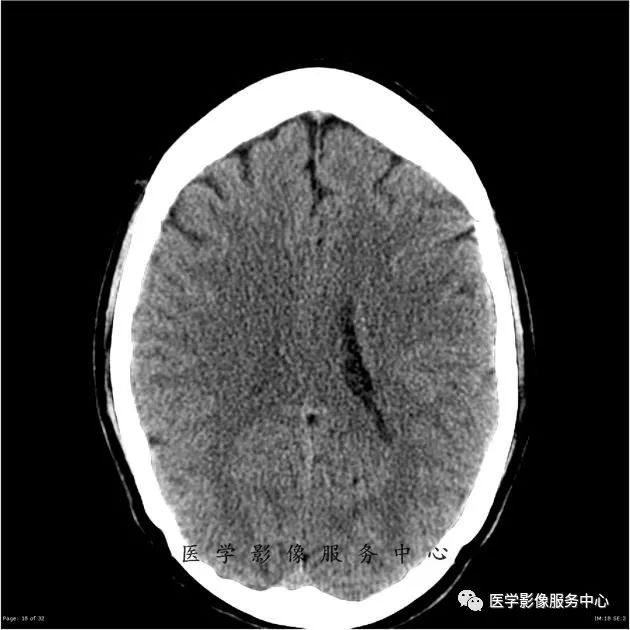 【病例】能在这个头颅CT上发现病变的都是高手—胚胎发育不良性神经上皮瘤1例 【病例】能在这个头颅CT上发现病变的都是高手—胚胎发育不良性神经上皮瘤1例