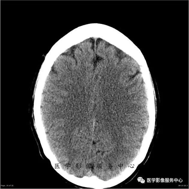 【病例】能在这个头颅CT上发现病变的都是高手—胚胎发育不良性神经上皮瘤1例 【病例】能在这个头颅CT上发现病变的都是高手—胚胎发育不良性神经上皮瘤1例
