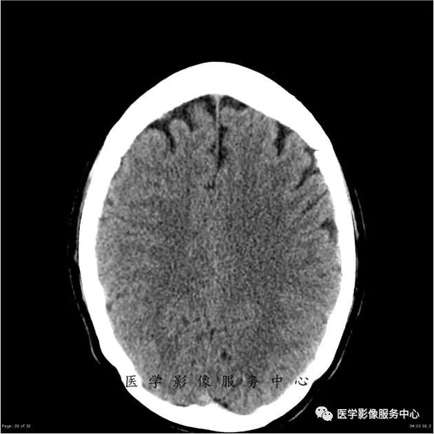 【病例】能在这个头颅CT上发现病变的都是高手—胚胎发育不良性神经上皮瘤1例 【病例】能在这个头颅CT上发现病变的都是高手—胚胎发育不良性神经上皮瘤1例