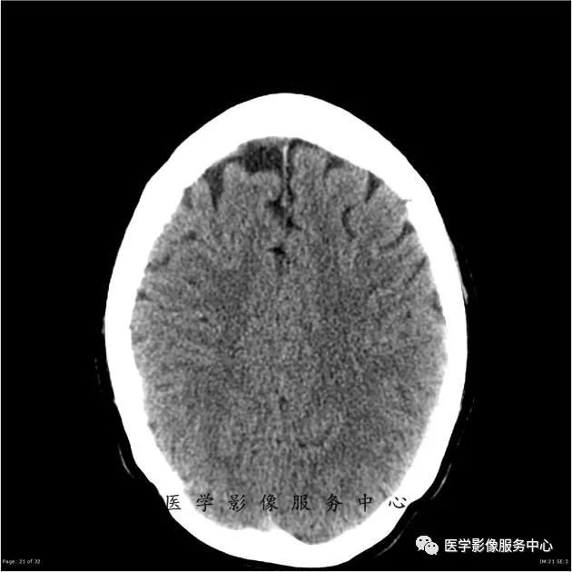 【病例】能在这个头颅CT上发现病变的都是高手—胚胎发育不良性神经上皮瘤1例 【病例】能在这个头颅CT上发现病变的都是高手—胚胎发育不良性神经上皮瘤1例