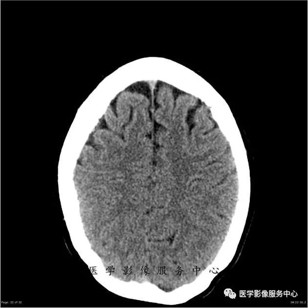 【病例】能在这个头颅CT上发现病变的都是高手—胚胎发育不良性神经上皮瘤1例 【病例】能在这个头颅CT上发现病变的都是高手—胚胎发育不良性神经上皮瘤1例
