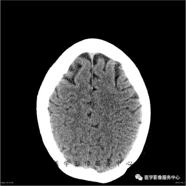 【病例】能在这个头颅CT上发现病变的都是高手—胚胎发育不良性神经上皮瘤1例 【病例】能在这个头颅CT上发现病变的都是高手—胚胎发育不良性神经上皮瘤1例