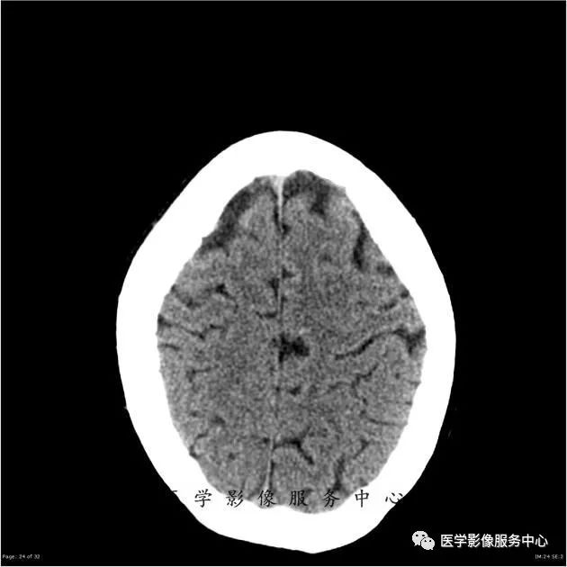 【病例】能在这个头颅CT上发现病变的都是高手—胚胎发育不良性神经上皮瘤1例 【病例】能在这个头颅CT上发现病变的都是高手—胚胎发育不良性神经上皮瘤1例