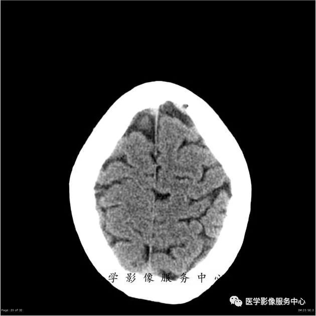 【病例】能在这个头颅CT上发现病变的都是高手—胚胎发育不良性神经上皮瘤1例 【病例】能在这个头颅CT上发现病变的都是高手—胚胎发育不良性神经上皮瘤1例