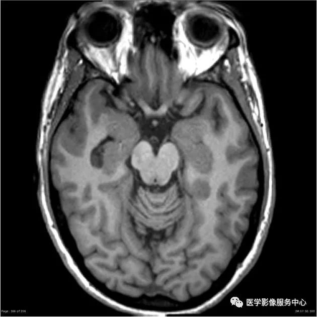 【病例】能在这个头颅CT上发现病变的都是高手—胚胎发育不良性神经上皮瘤1例 【病例】能在这个头颅CT上发现病变的都是高手—胚胎发育不良性神经上皮瘤1例