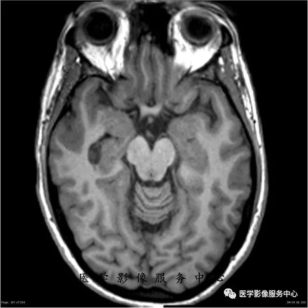 【病例】能在这个头颅CT上发现病变的都是高手—胚胎发育不良性神经上皮瘤1例 【病例】能在这个头颅CT上发现病变的都是高手—胚胎发育不良性神经上皮瘤1例