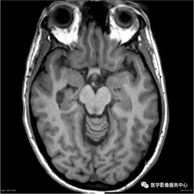 【病例】能在这个头颅CT上发现病变的都是高手—胚胎发育不良性神经上皮瘤1例 【病例】能在这个头颅CT上发现病变的都是高手—胚胎发育不良性神经上皮瘤1例