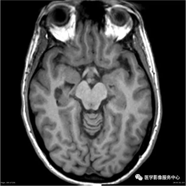 【病例】能在这个头颅CT上发现病变的都是高手—胚胎发育不良性神经上皮瘤1例 【病例】能在这个头颅CT上发现病变的都是高手—胚胎发育不良性神经上皮瘤1例