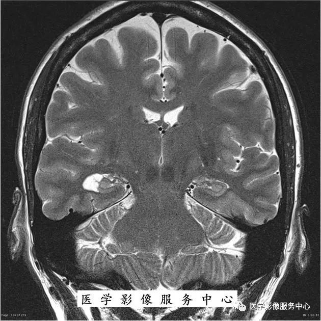 【病例】能在这个头颅CT上发现病变的都是高手—胚胎发育不良性神经上皮瘤1例 【病例】能在这个头颅CT上发现病变的都是高手—胚胎发育不良性神经上皮瘤1例