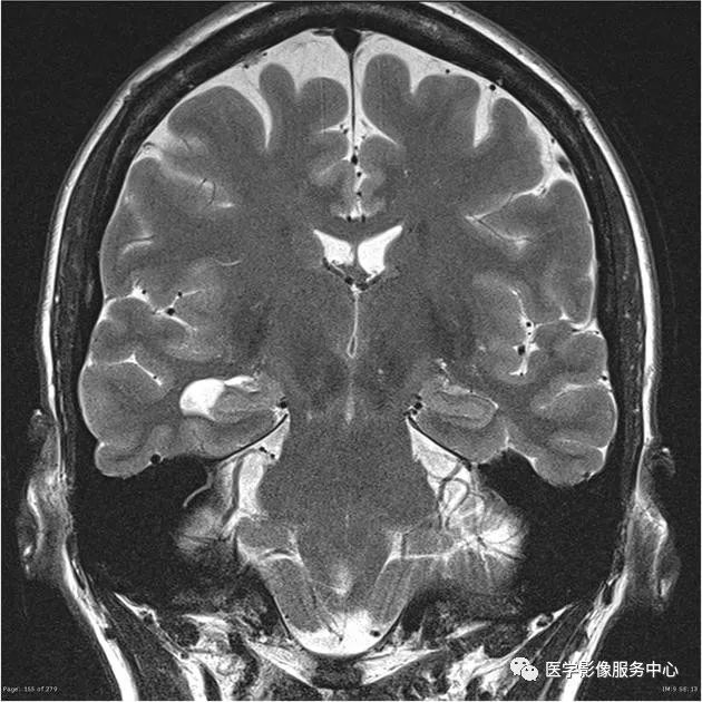 【病例】能在这个头颅CT上发现病变的都是高手—胚胎发育不良性神经上皮瘤1例 【病例】能在这个头颅CT上发现病变的都是高手—胚胎发育不良性神经上皮瘤1例