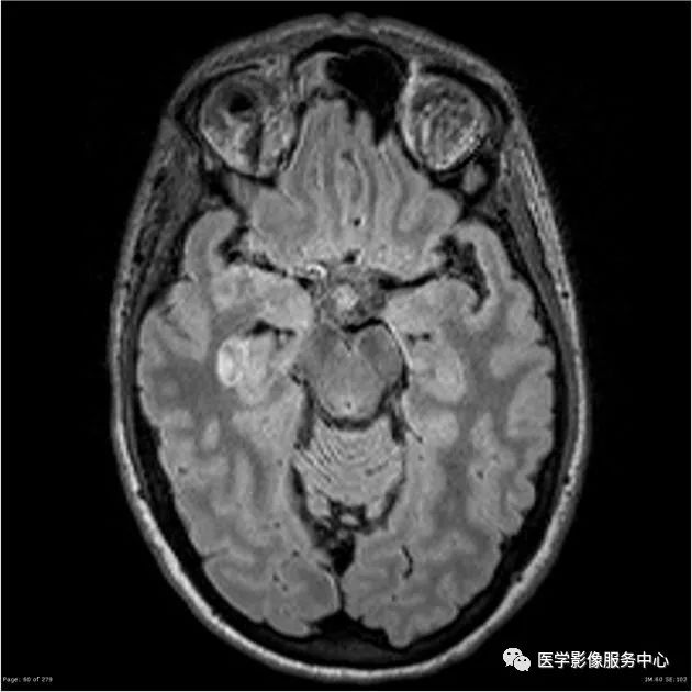 【病例】能在这个头颅CT上发现病变的都是高手—胚胎发育不良性神经上皮瘤1例 【病例】能在这个头颅CT上发现病变的都是高手—胚胎发育不良性神经上皮瘤1例